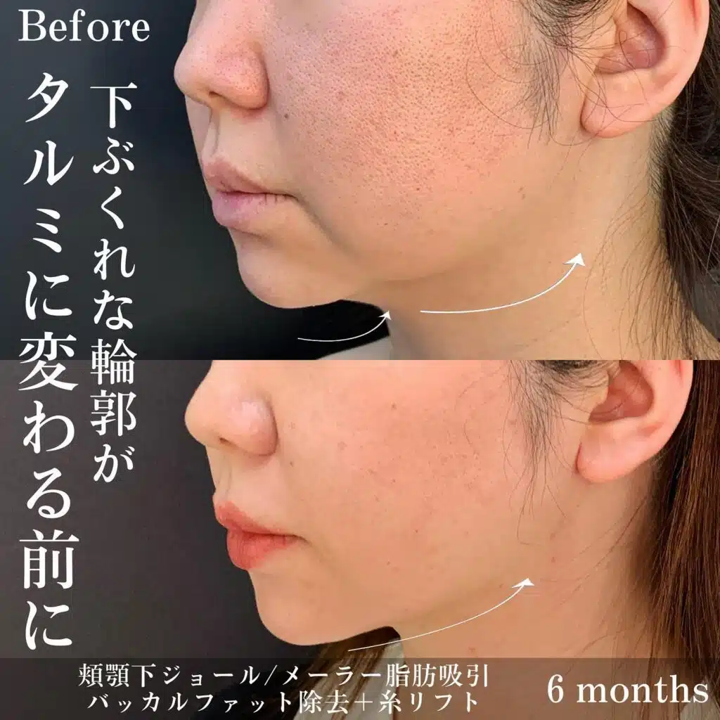 ジョールファット除去