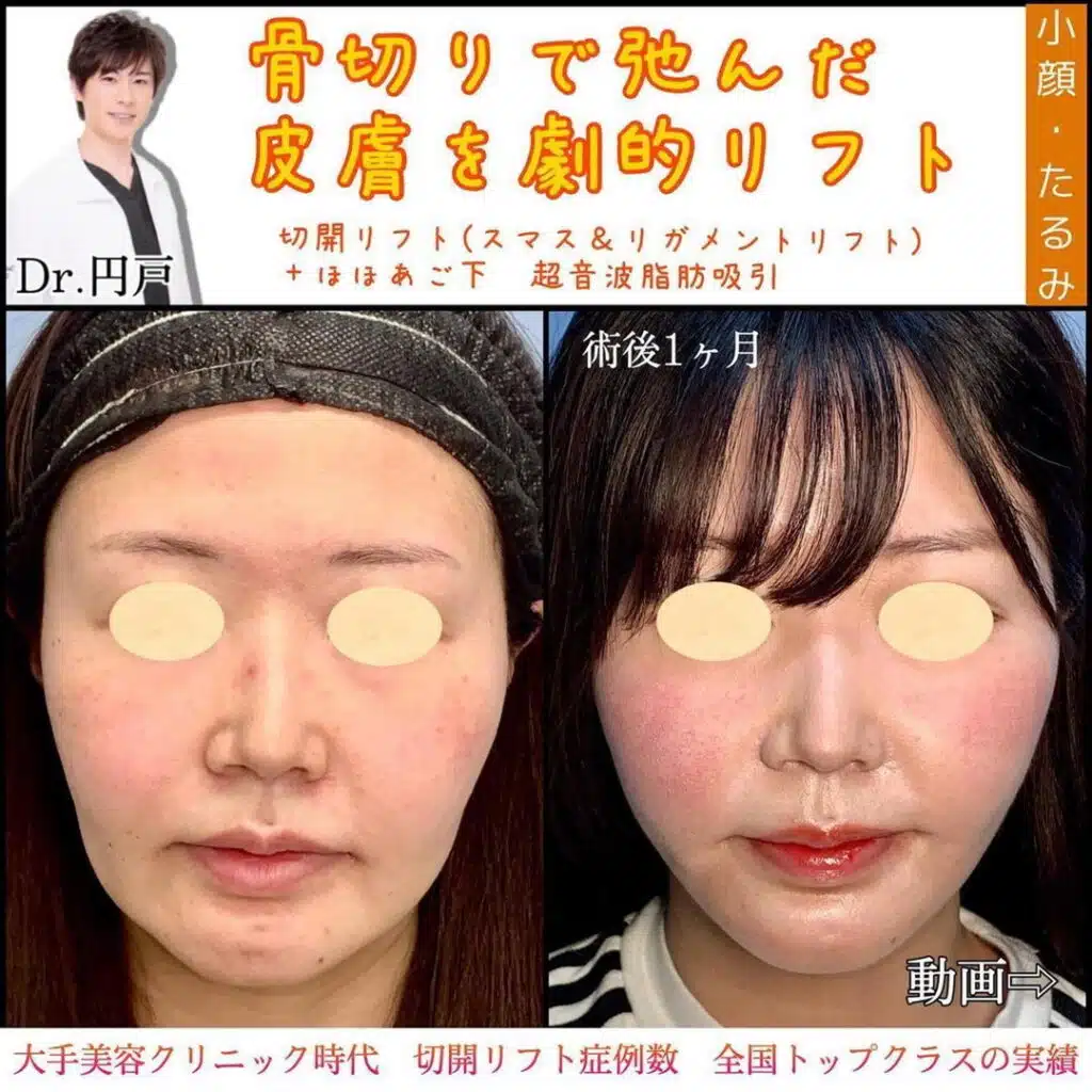 フェイスリフト(切開リフト)