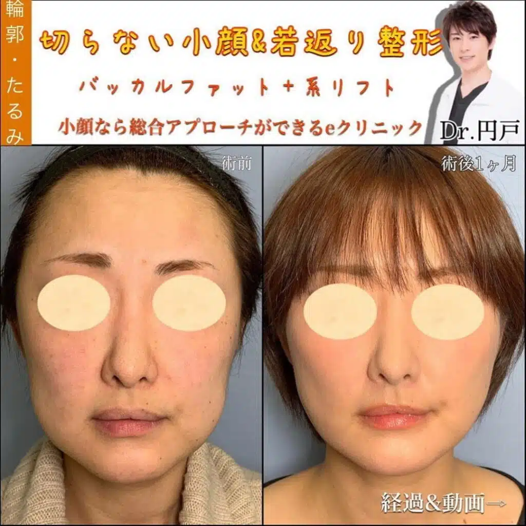 バッカルファット除去