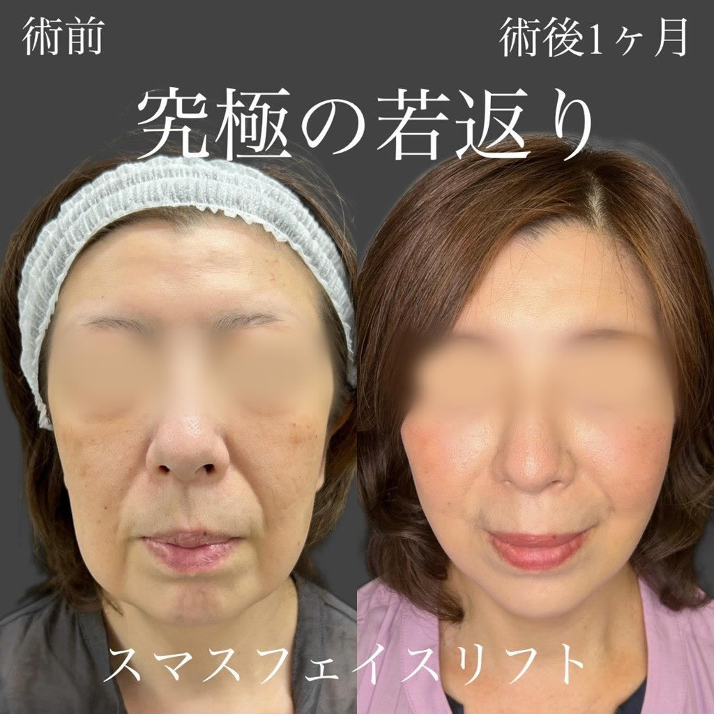 フェイスリフト