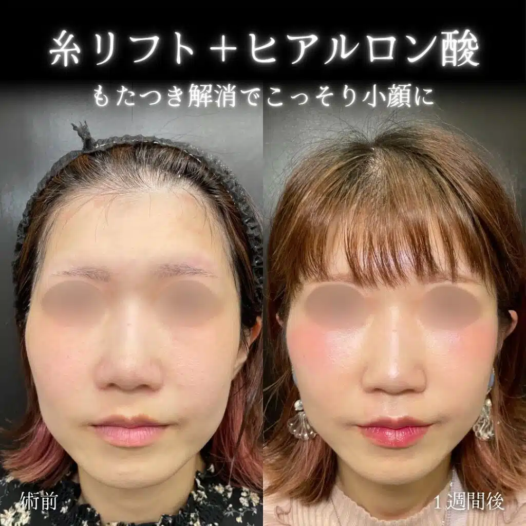 ヒアルロン酸(あご・ほほ・こめかみ)