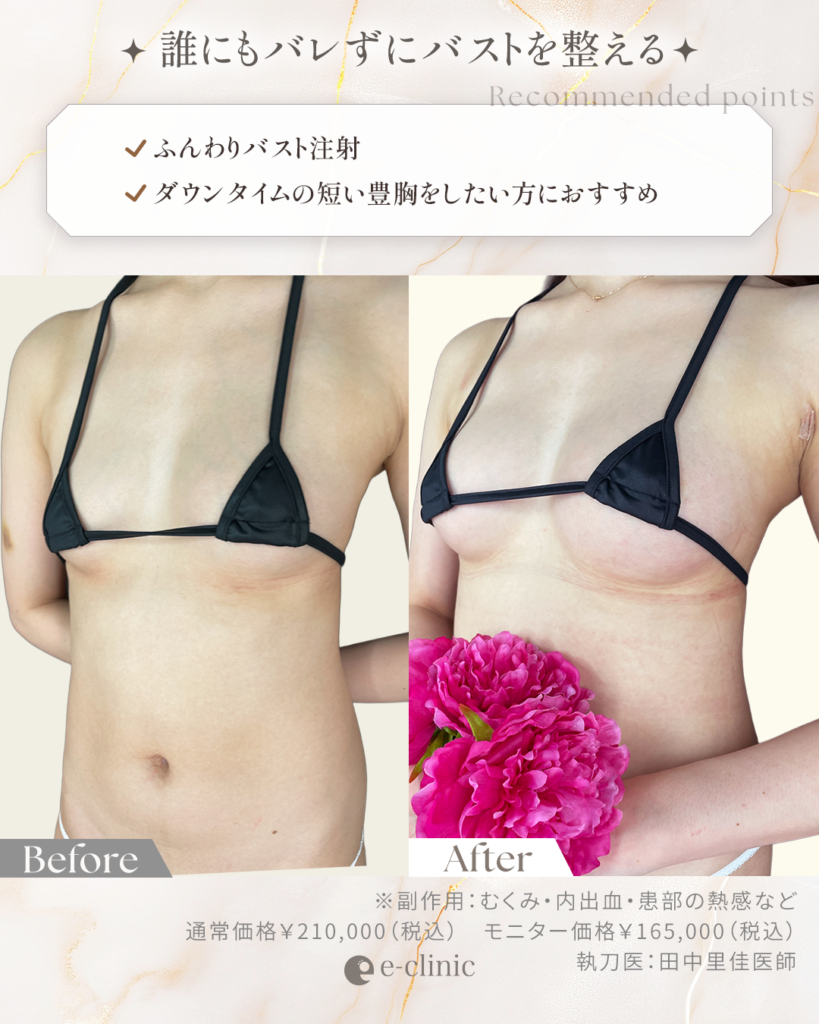 ふんわりバスト症例画像_1