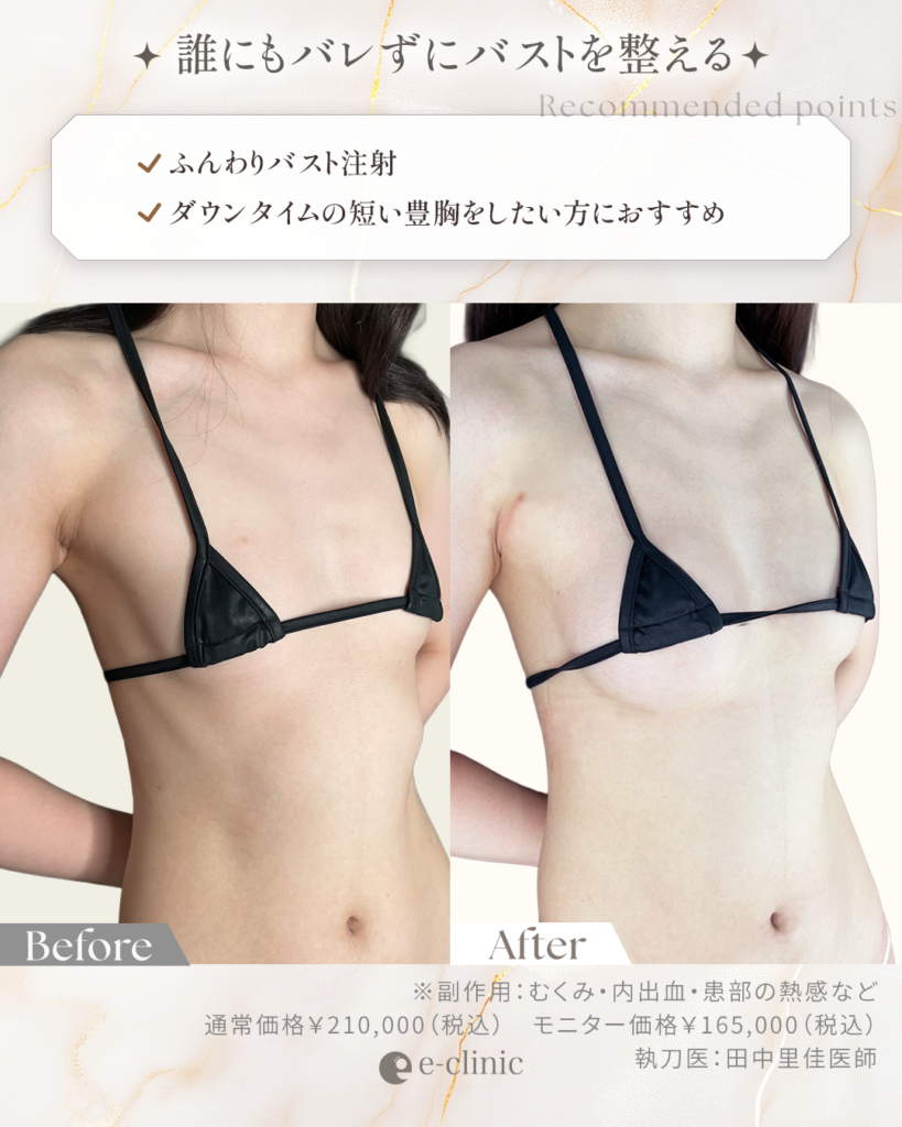 ふんわりバスト症例画像_2