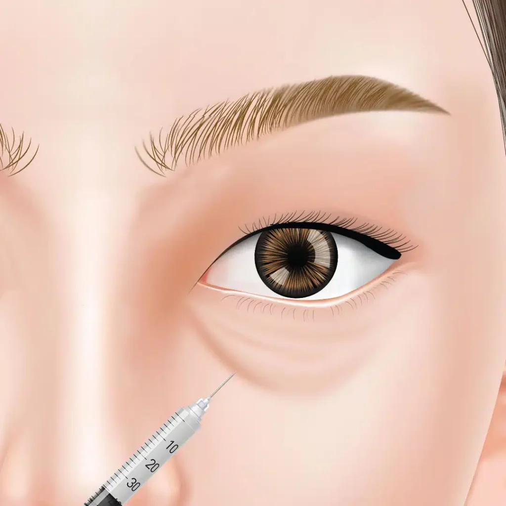 目の下のヒアルロン酸注射　富山駅前