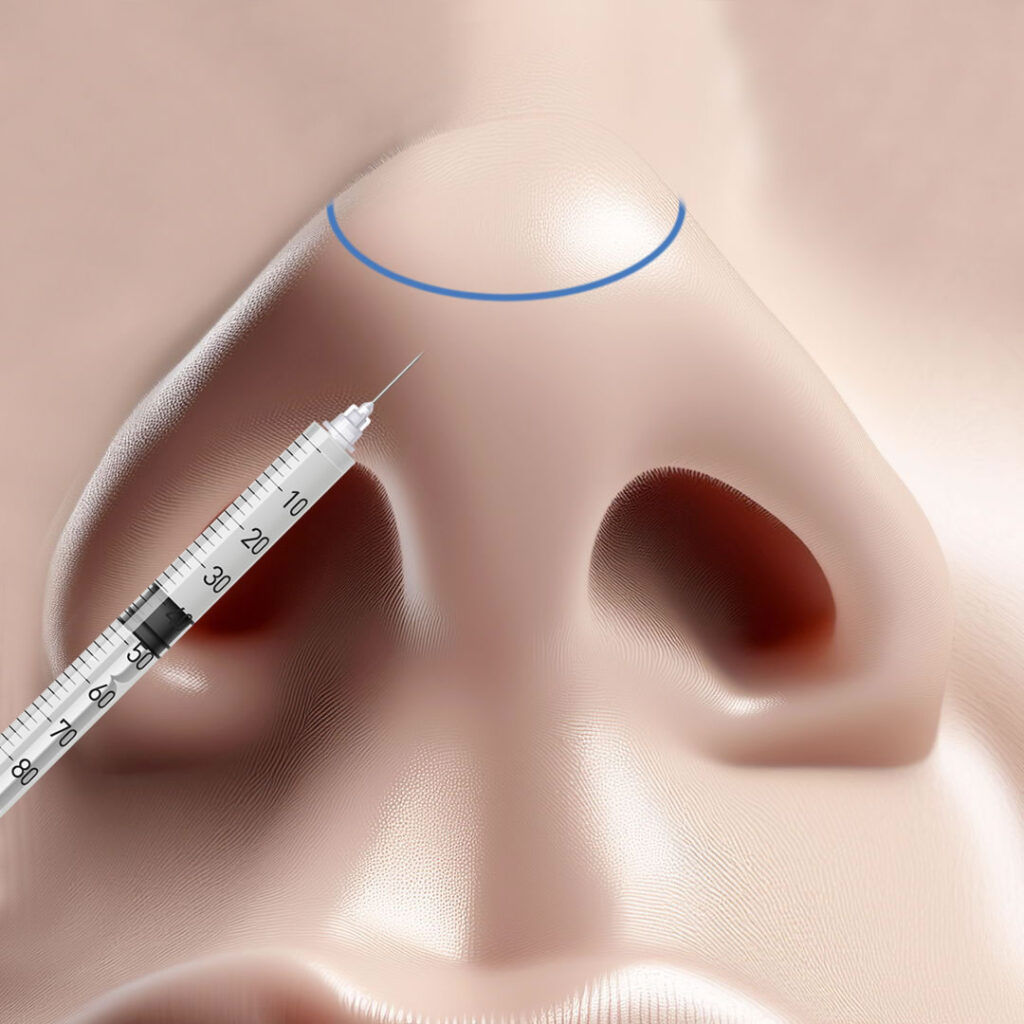 鼻に麻酔注射をしているところ