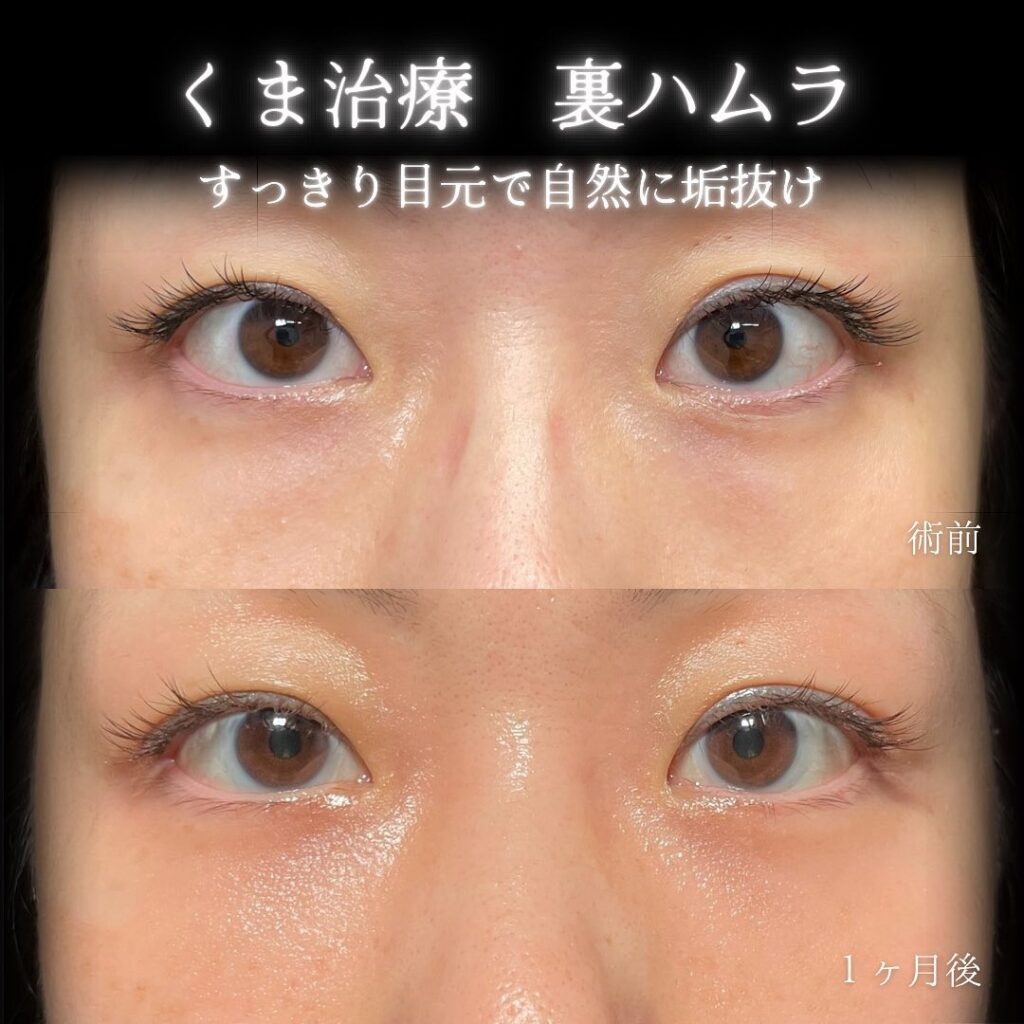 eクリニック富山駅前院の裏ハムラの症例画像（5）