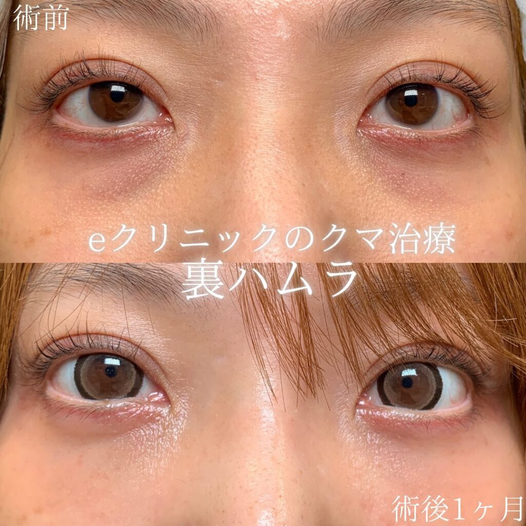 eクリニック富山駅前院の裏ハムラの症例画像（1）