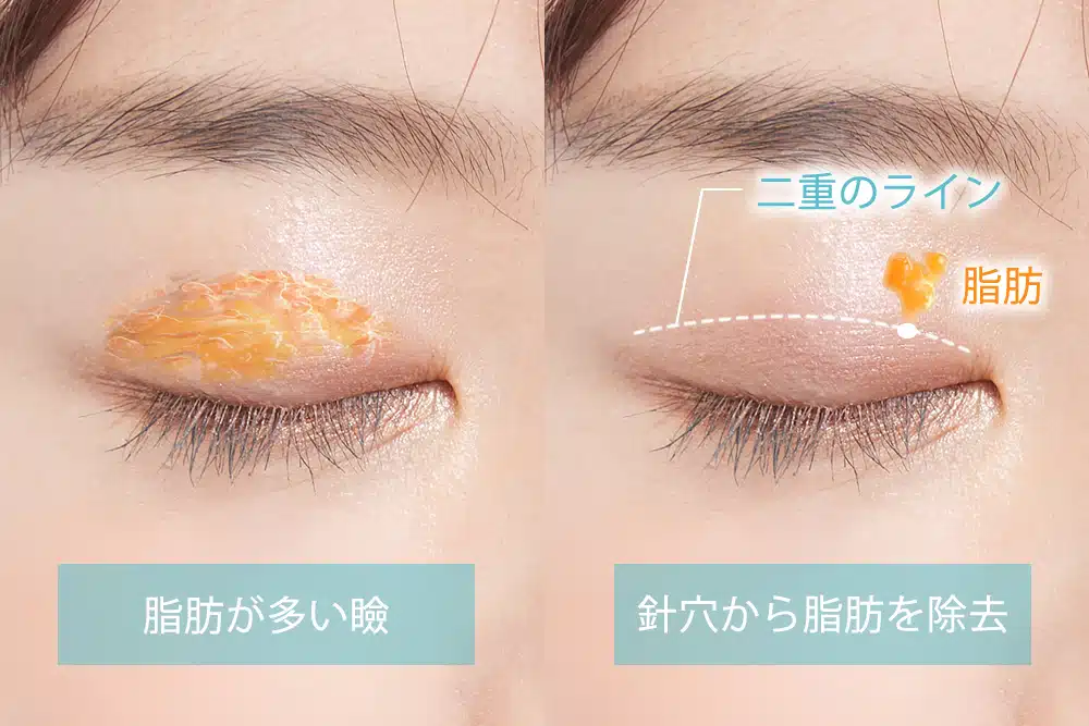 まぶたの脂肪取り　富山駅前