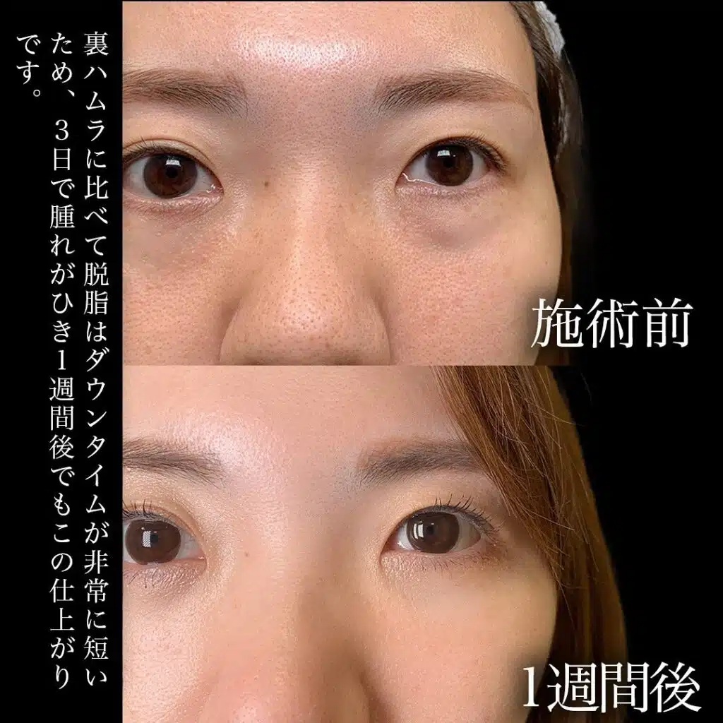 経結膜脱脂　富山駅前