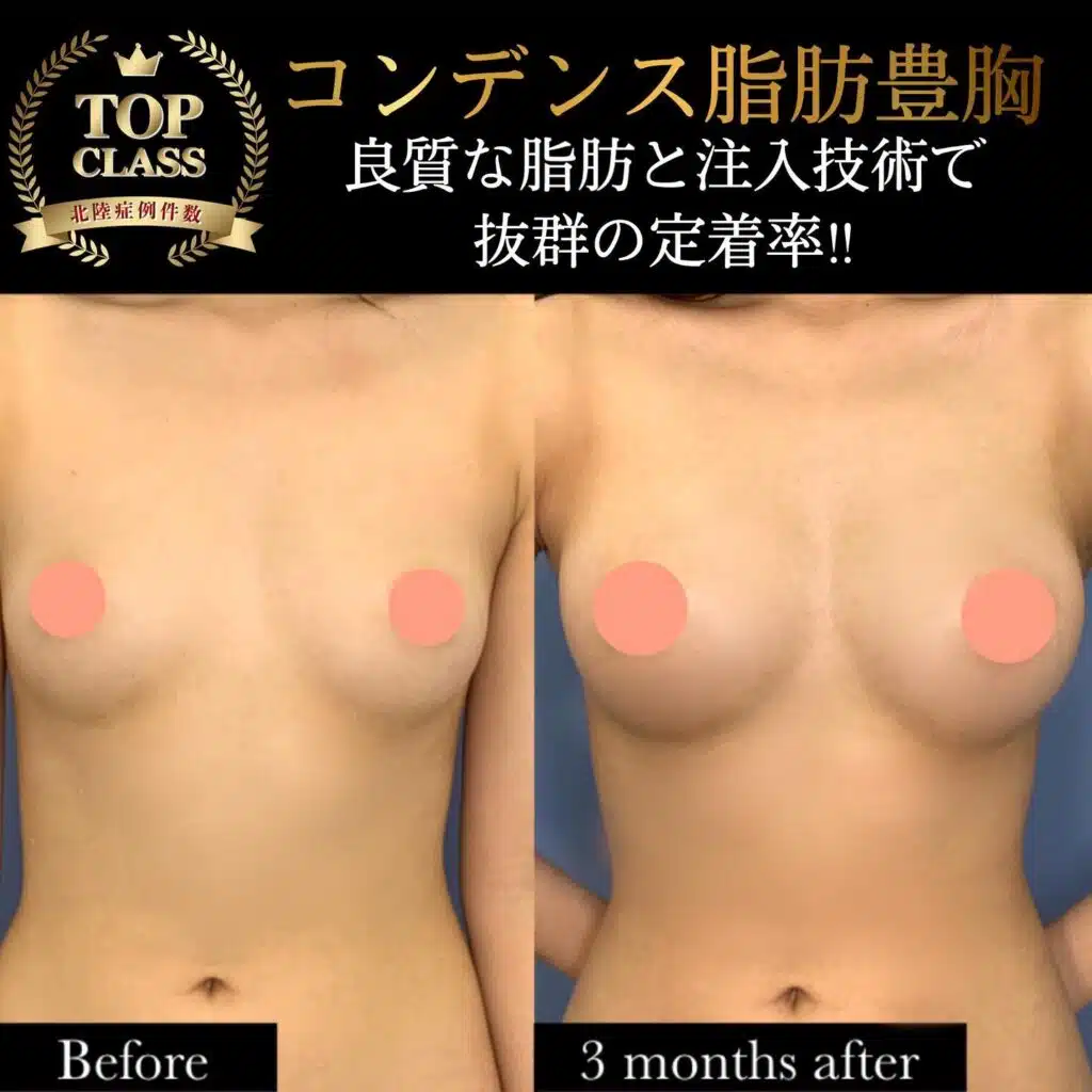 コンデンス脂肪豊胸　富山駅前