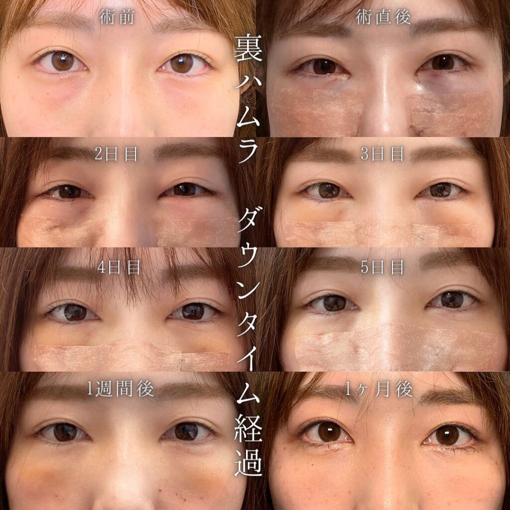 裏ハムラダウンタイム経過