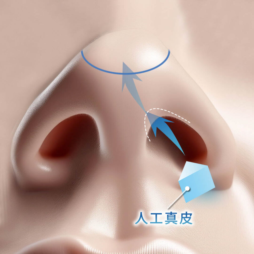 鼻尖部人工真皮を挿入している図解