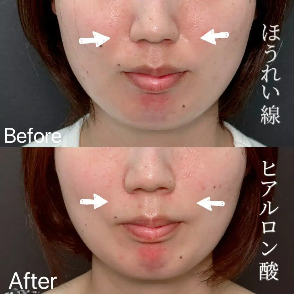 ほうれい線 ヒアルロン酸 富山駅前