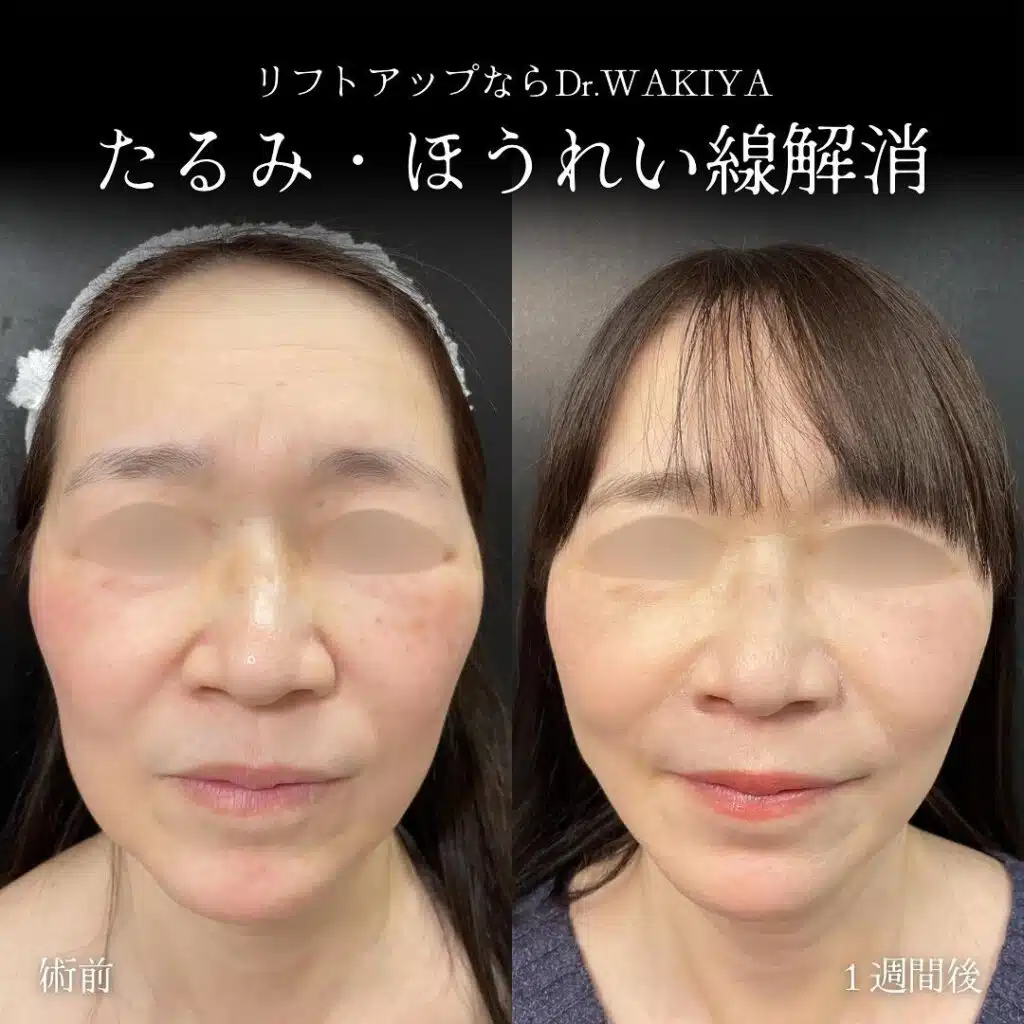 たるみ・ほうれい線解消 富山駅前