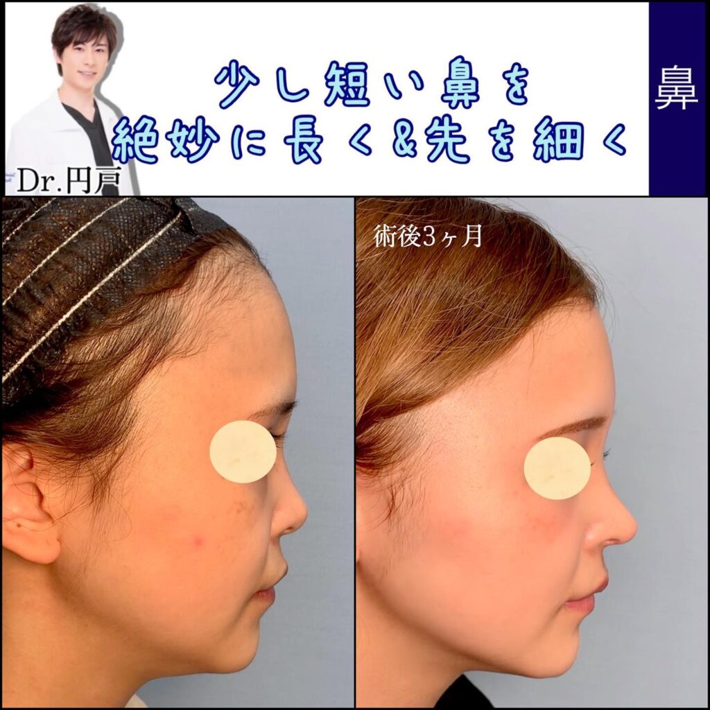 鼻尖形成の症例写真