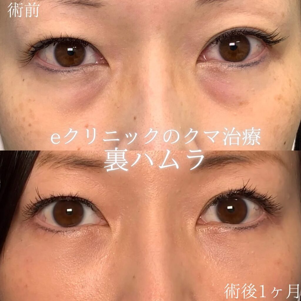 eクリニック富山駅前院の裏ハムラの症例画像（3）