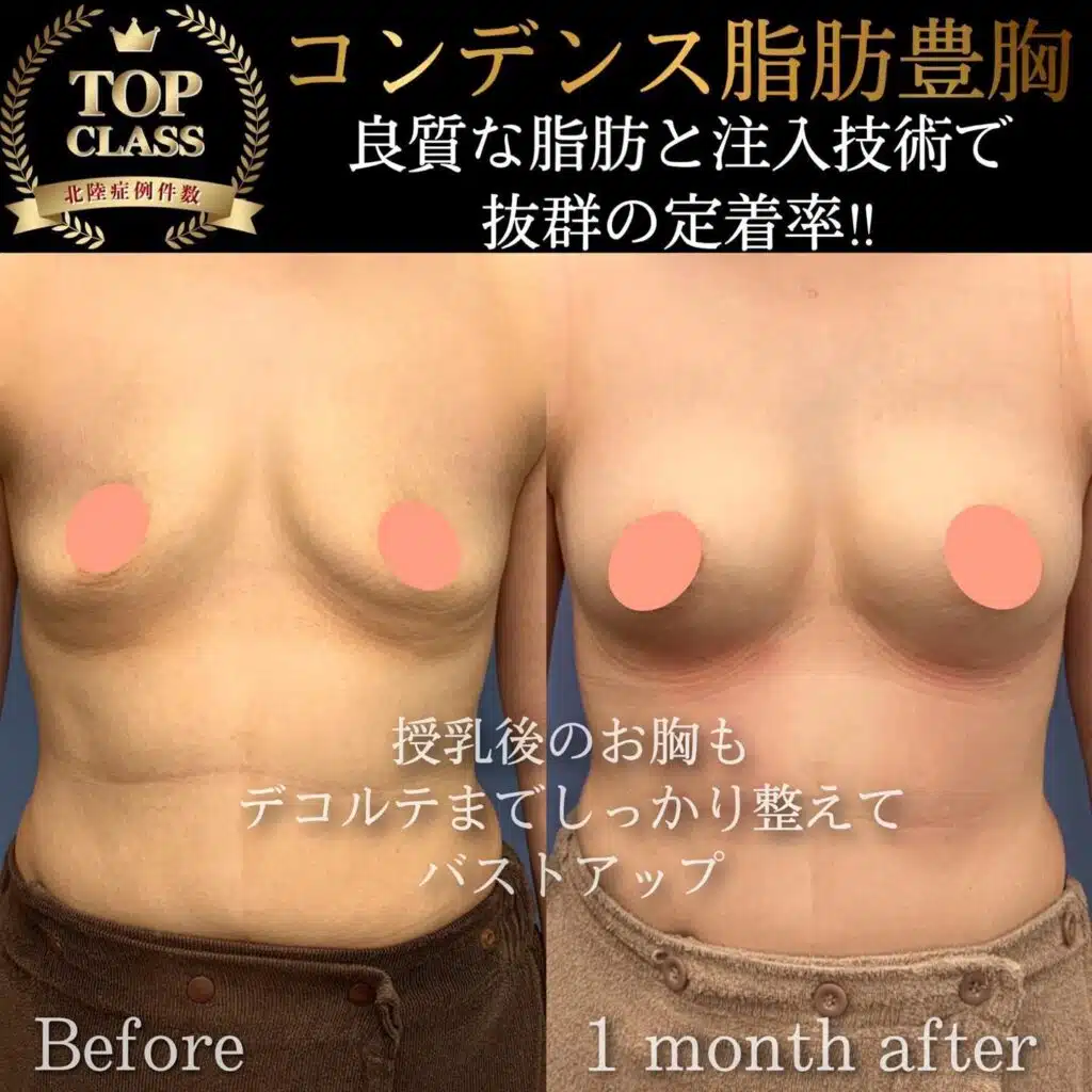 コンデンス脂肪豊胸　富山駅前