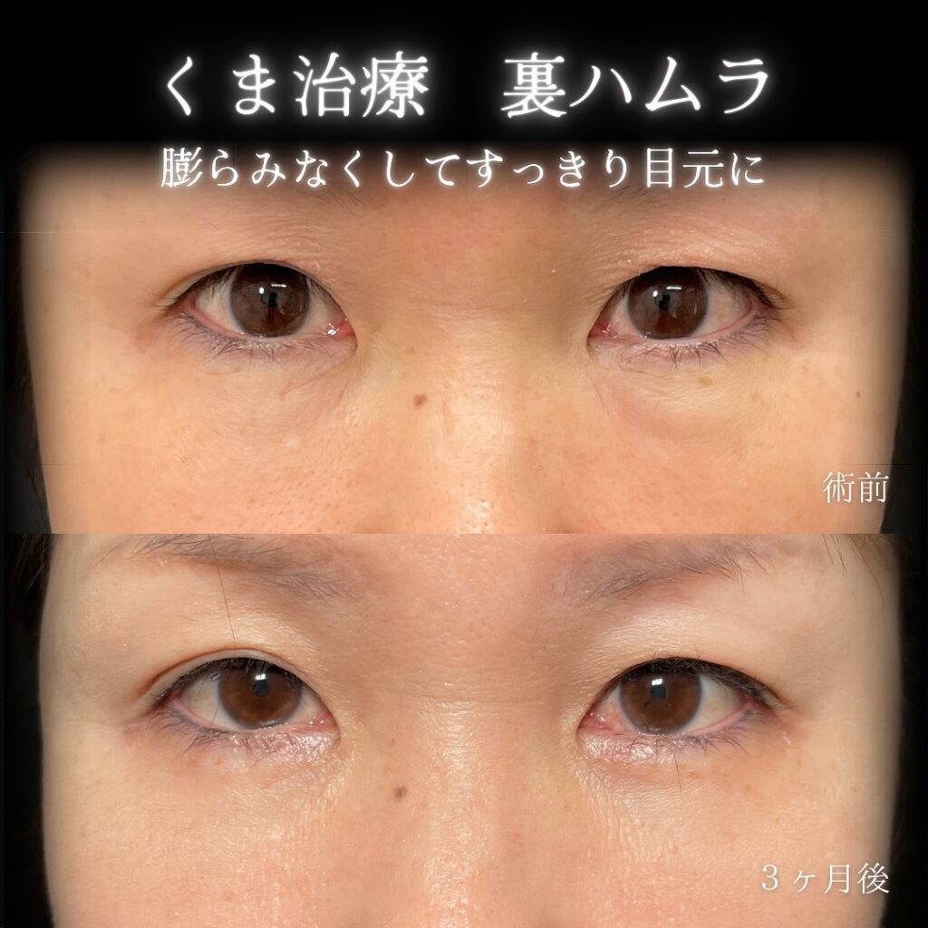 eクリニック富山駅前院の裏ハムラの症例画像（6）