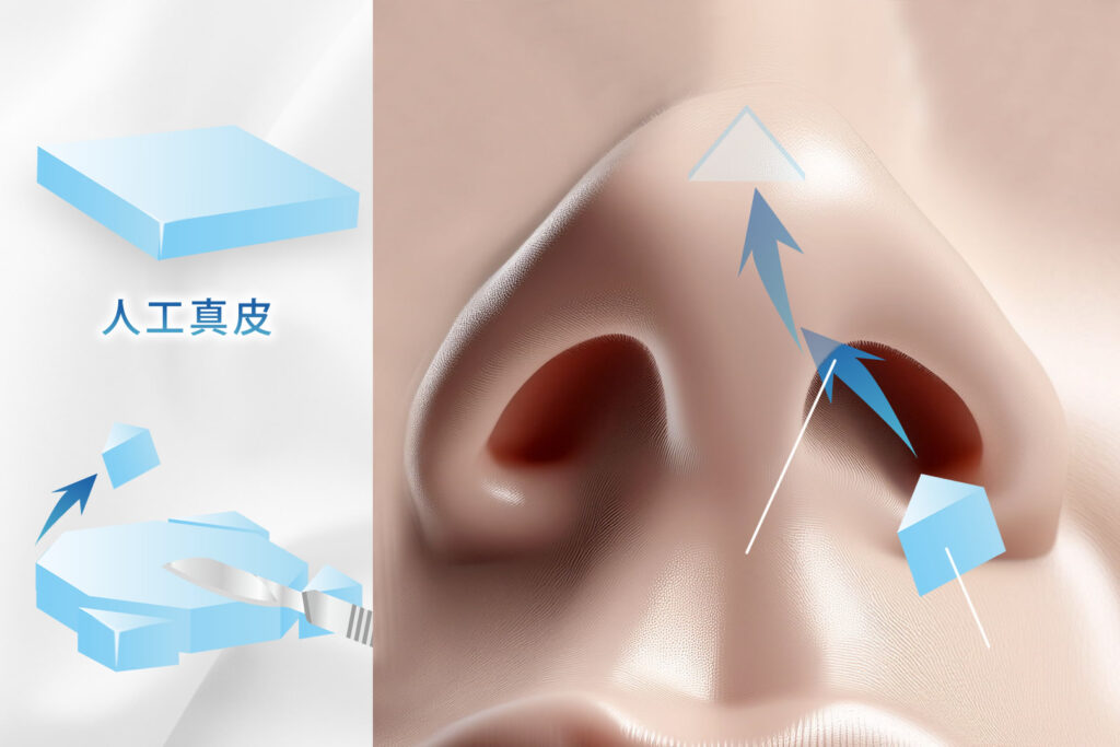 人工真皮の図解