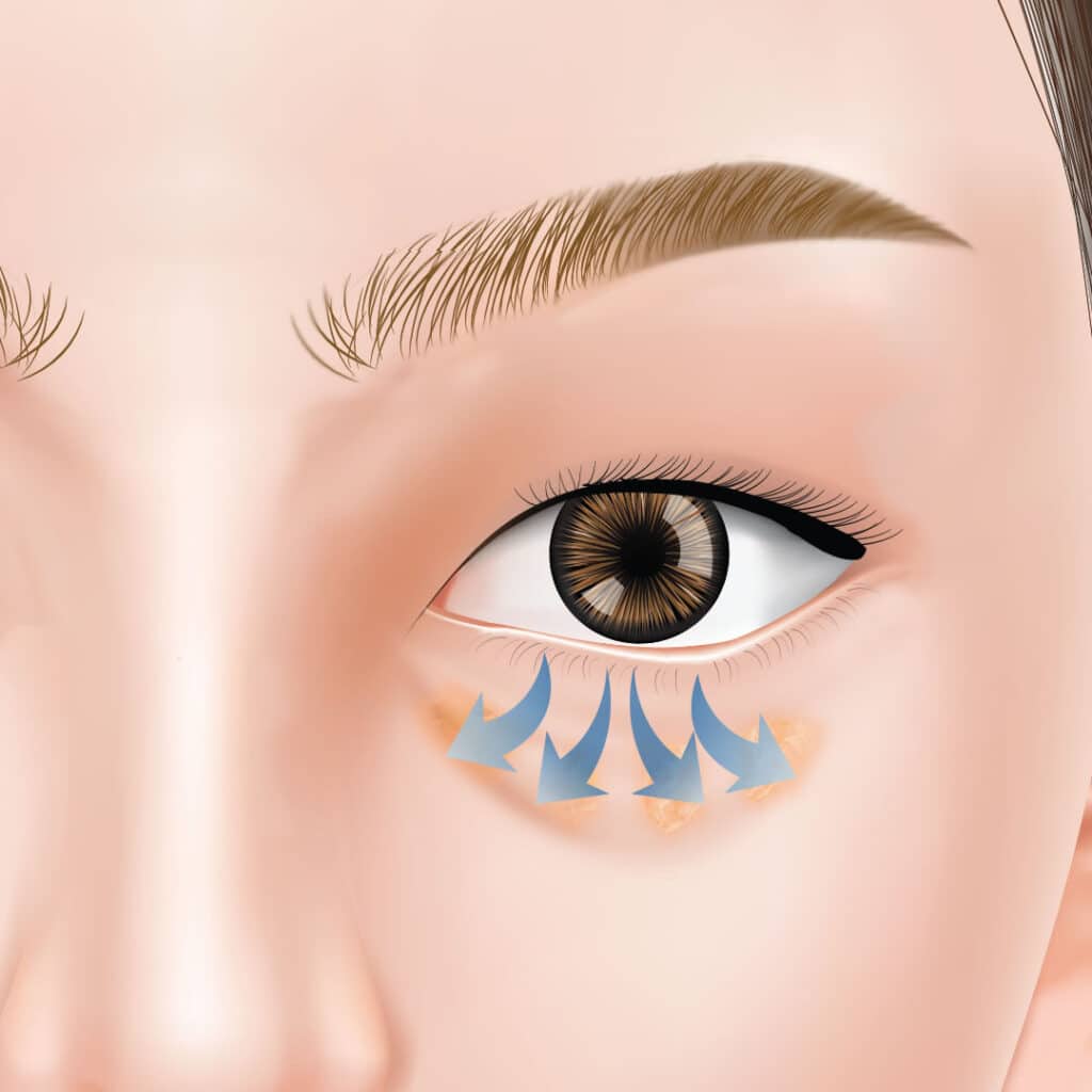 表ハムラの眼窩脂肪再配置