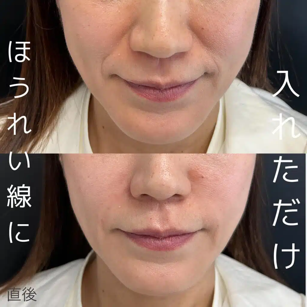 ほうれい線に入れただけ 富山駅前