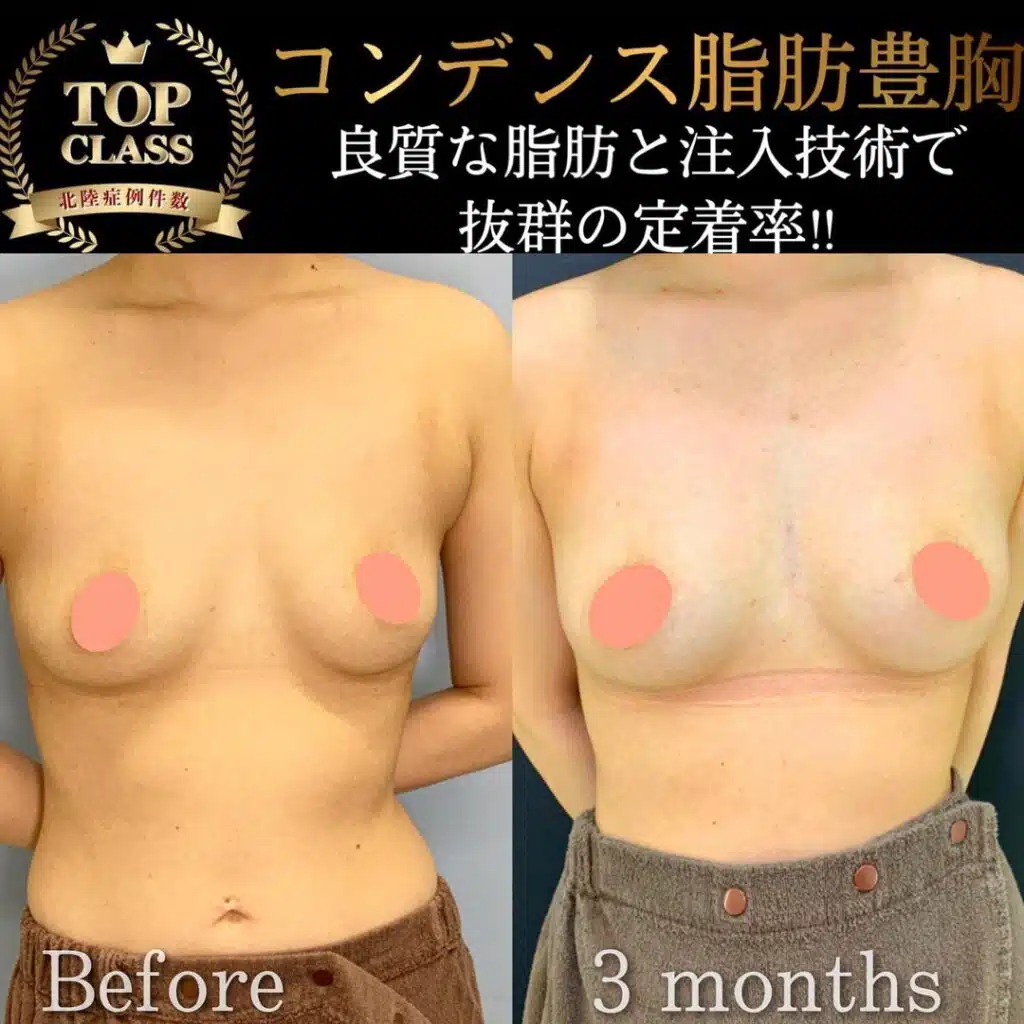 コンデンス豊胸　富山駅前