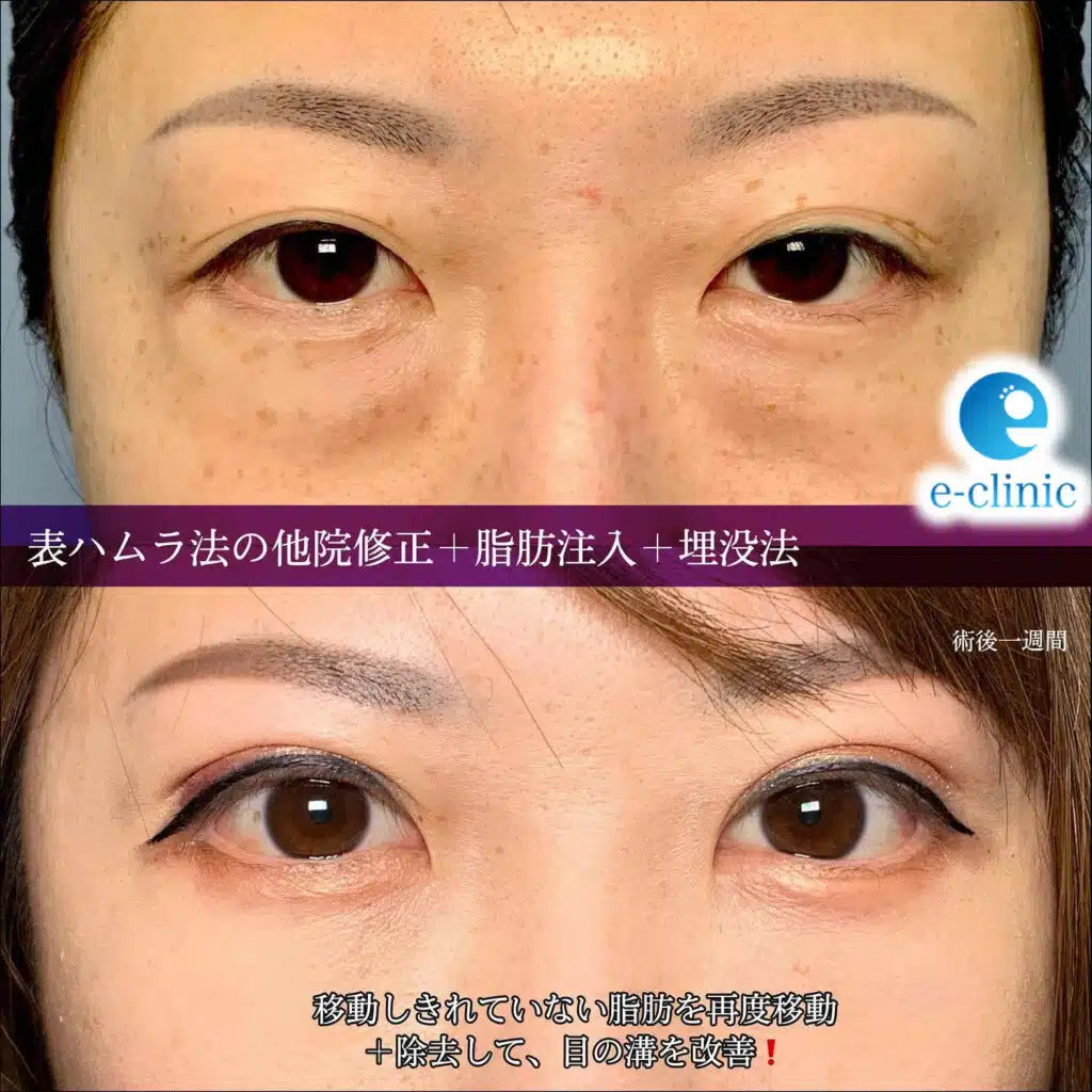 表ハムラ法　他院修正　脂肪注入　埋没法　富山駅前