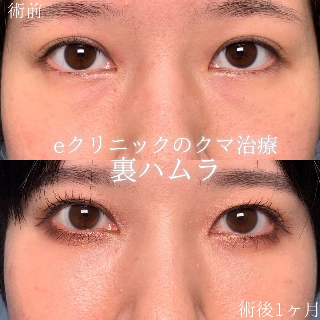 eクリニック富山駅前院の裏ハムラの症例画像（2）