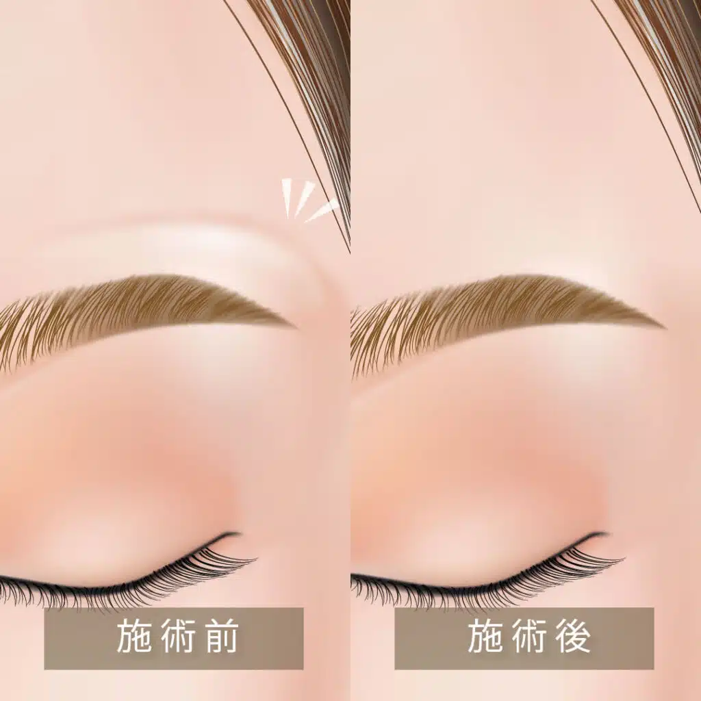 眉上ボトックス　富山駅前