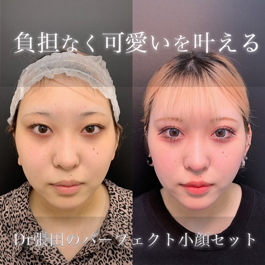 頬と顎下の脂肪吸引とジョールファットとメーラーファットと糸リフトと顎のヒアルロン酸注入の症例写真 (1)