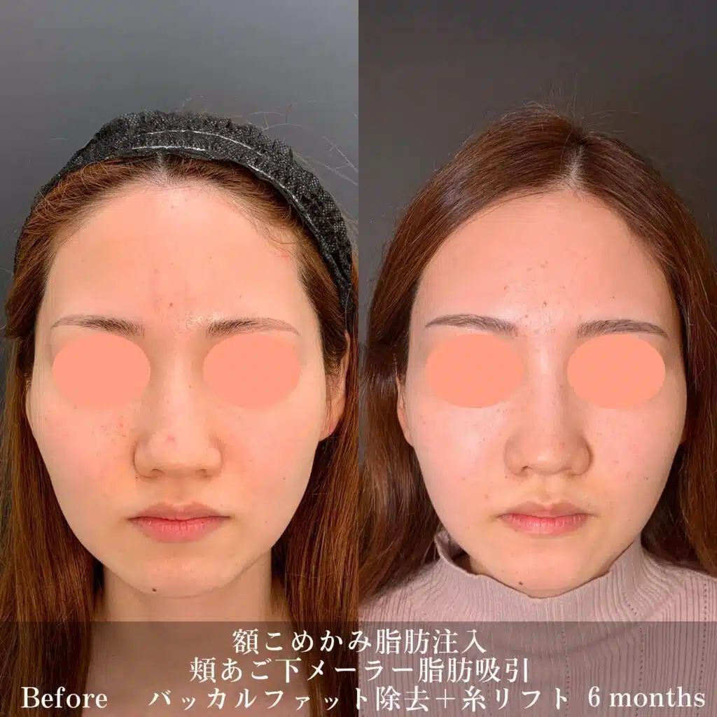 額こめかみ脂肪注入 頬あご下メーラー脂肪吸引 バッカルファット除去+糸リフト 富山駅前