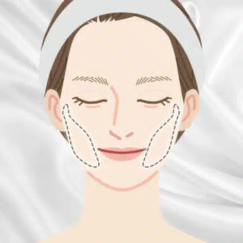 バッカルファット除去　富山駅前