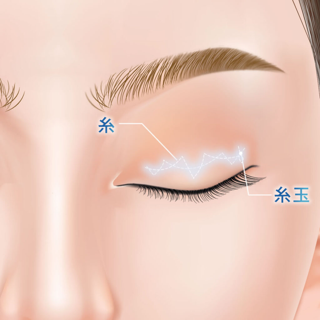 埋没法の自然癒着法の図解