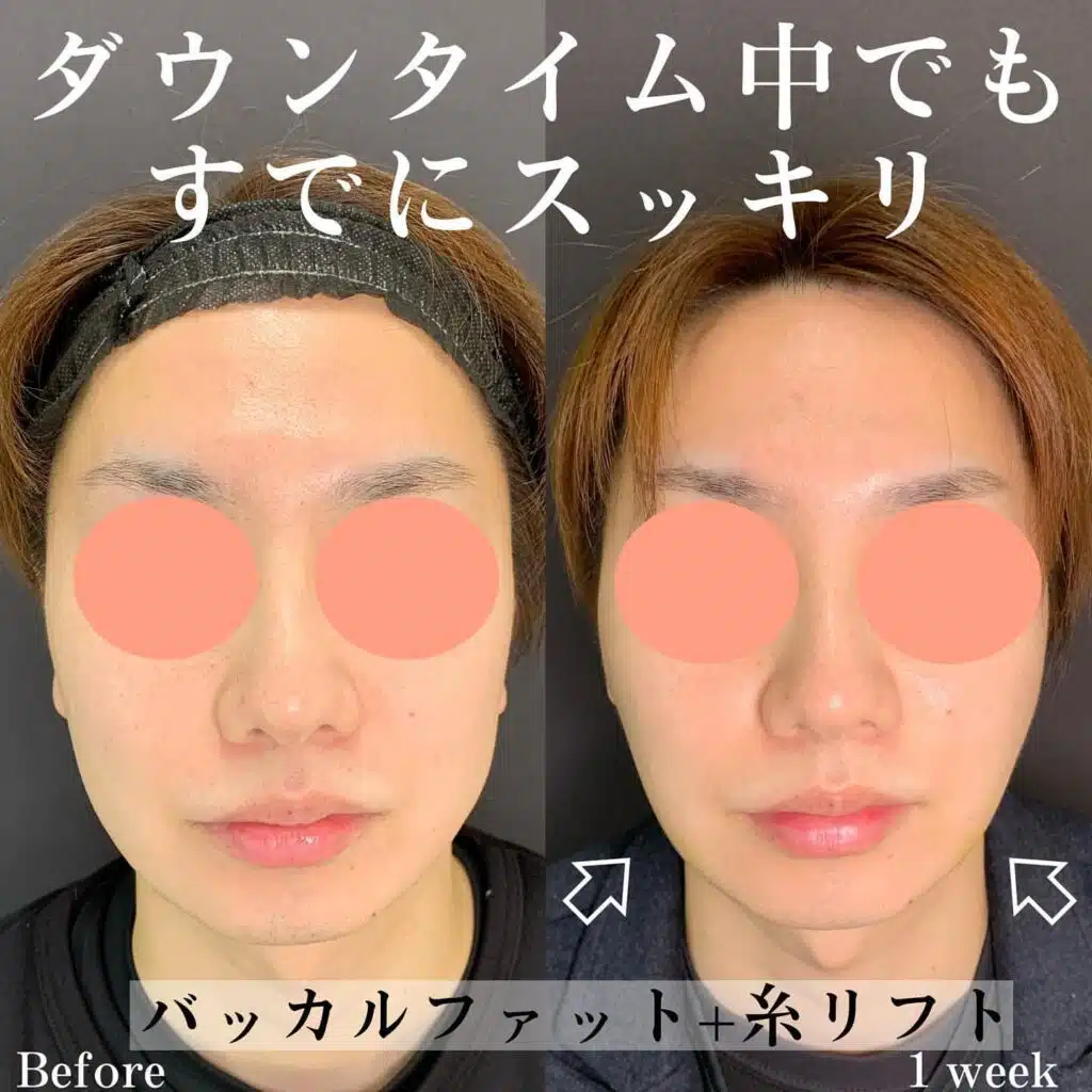 バッカルファット+糸リフト 富山駅前