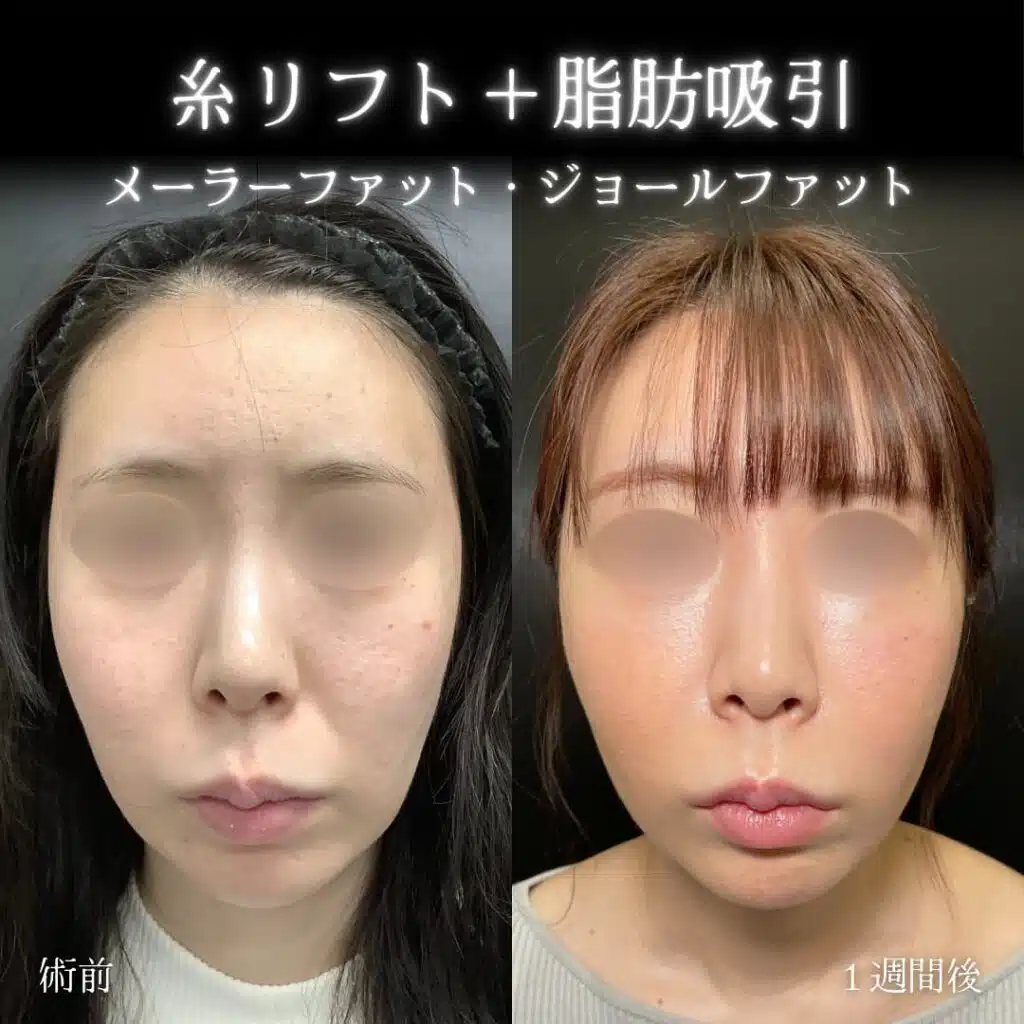 糸リフト+脂肪吸引 富山駅前