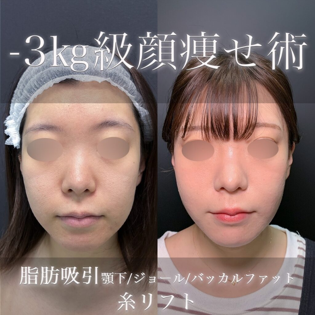 小顔の脂肪吸引とジョールファットとバッカルファットと糸リフトの症例写真 (1)