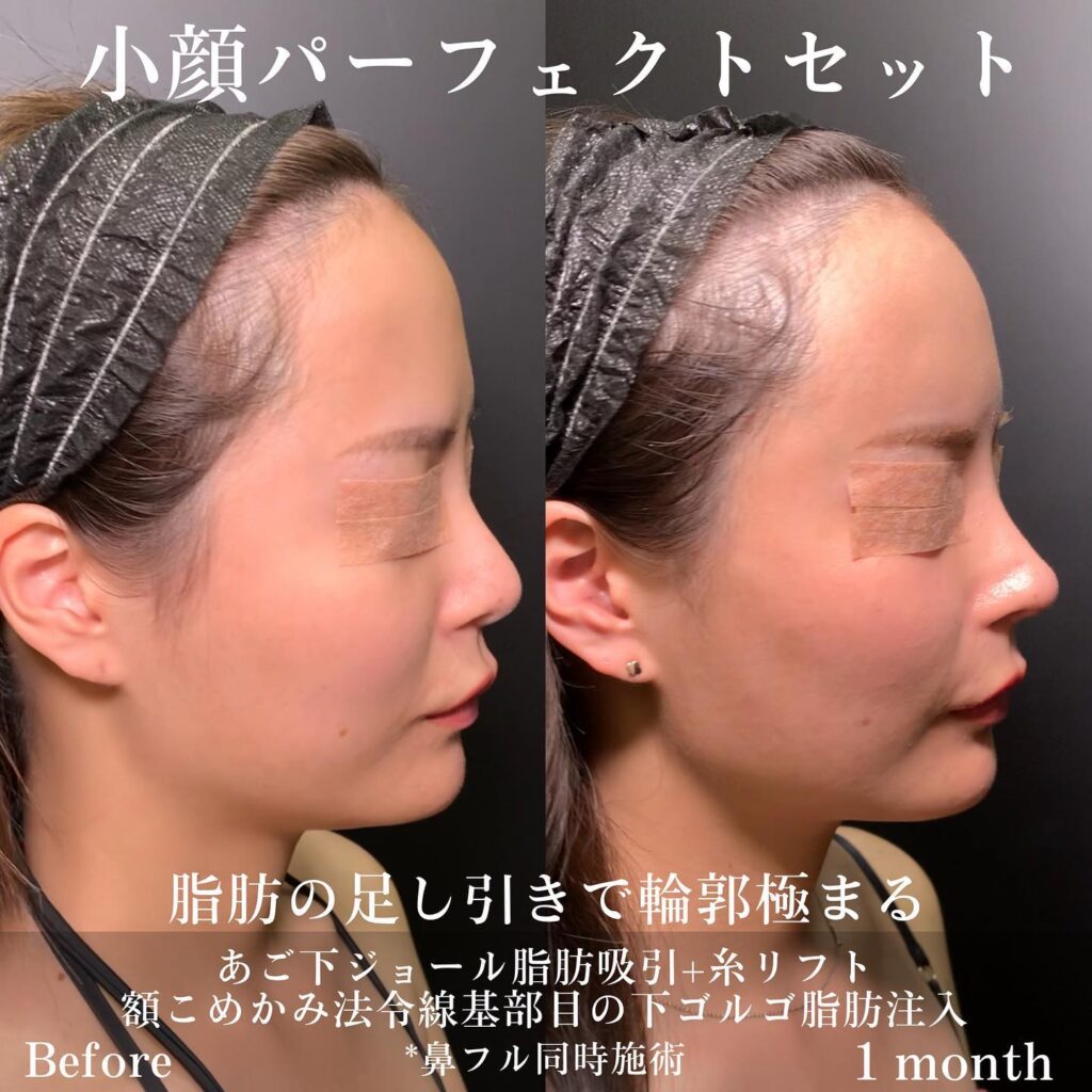 顎下のジョールファットと小顔脂肪吸引と糸リフトと脂肪注入と鼻フルの症例写真 (2)