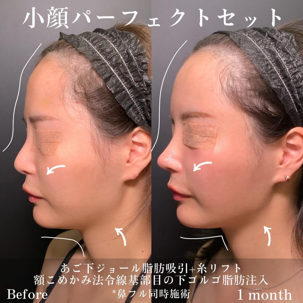 顎下のジョールファットと小顔脂肪吸引と糸リフトと脂肪注入と鼻フルの症例写真 (3)