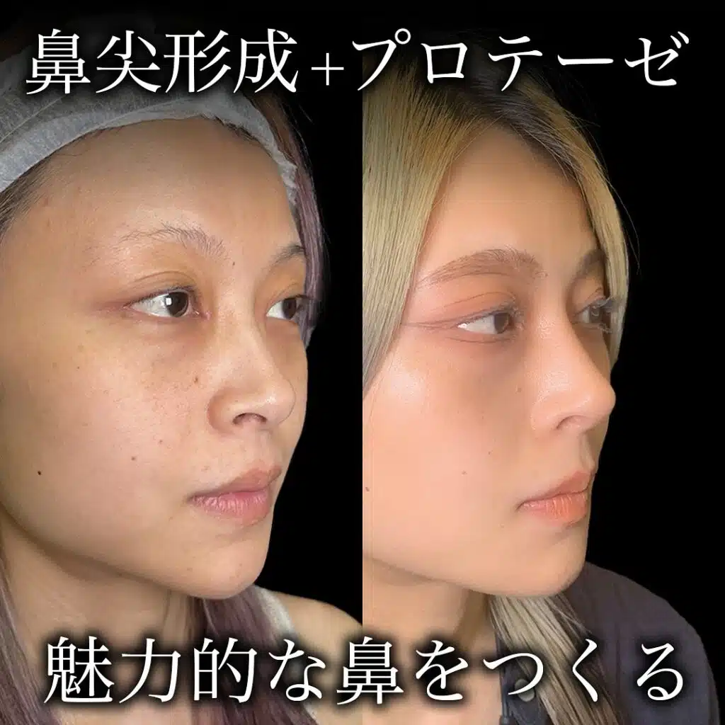 鼻尖形成+プロテーゼ 横浜みなとみらい
