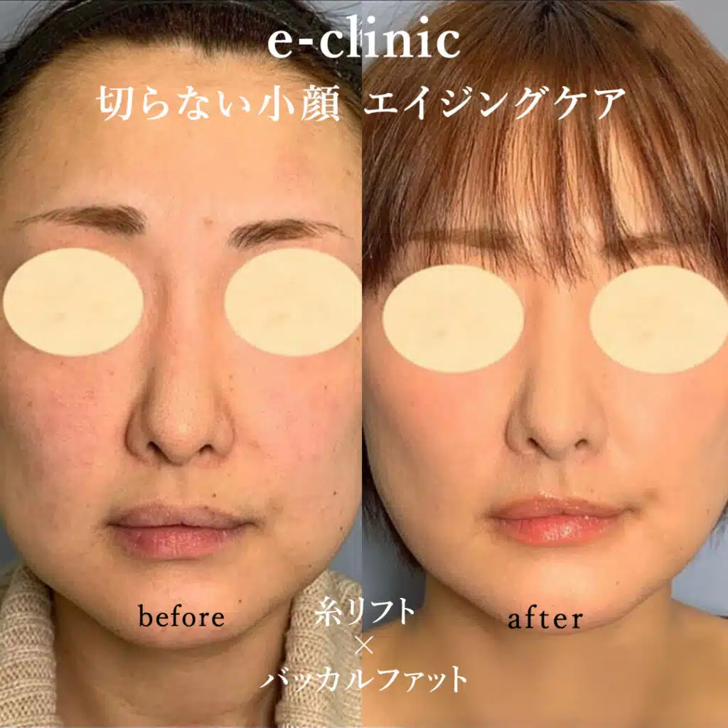 切らない小顔 エイジングケア 糸リフト×バッカルファット 富山駅前