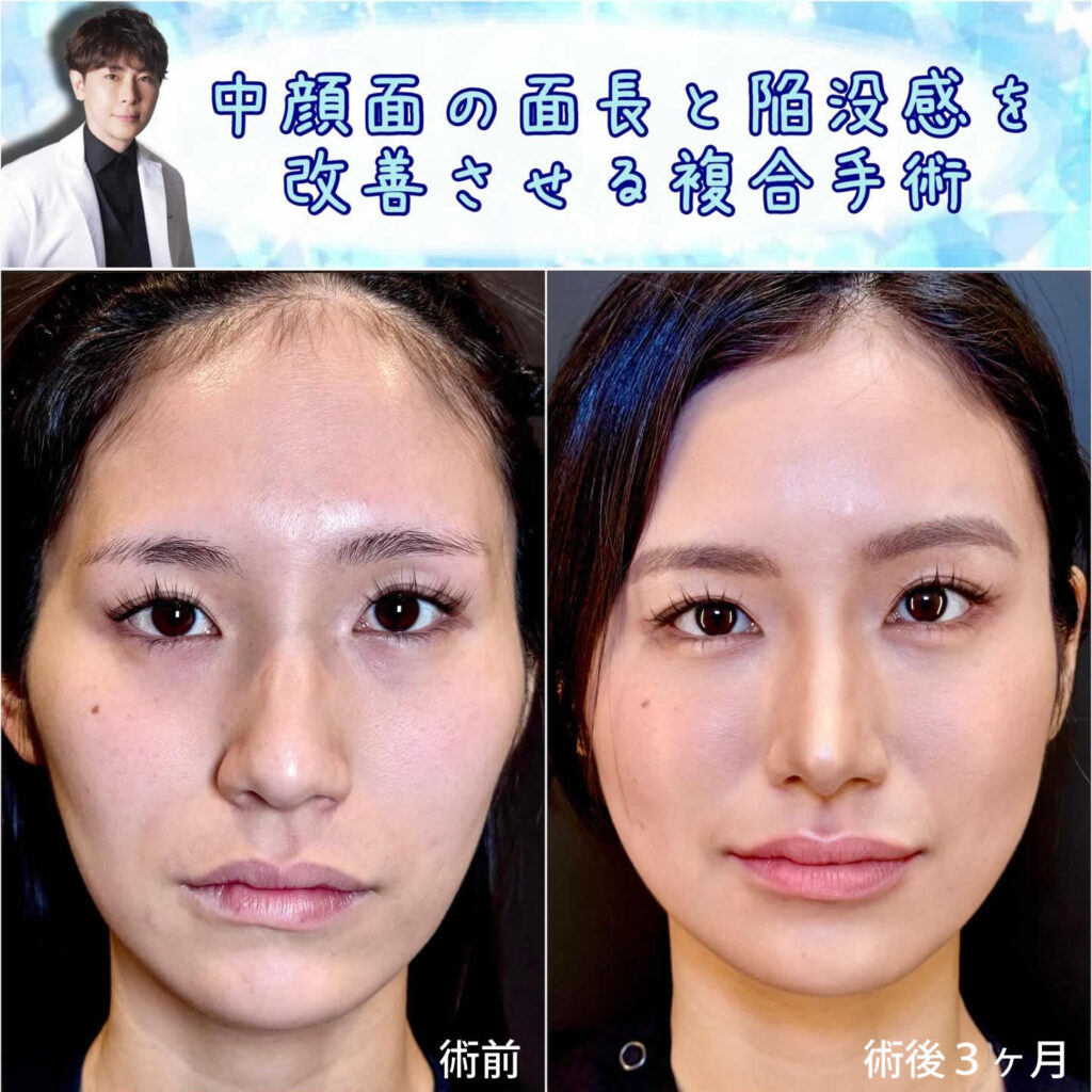 中顔面陥没整形の症例写真