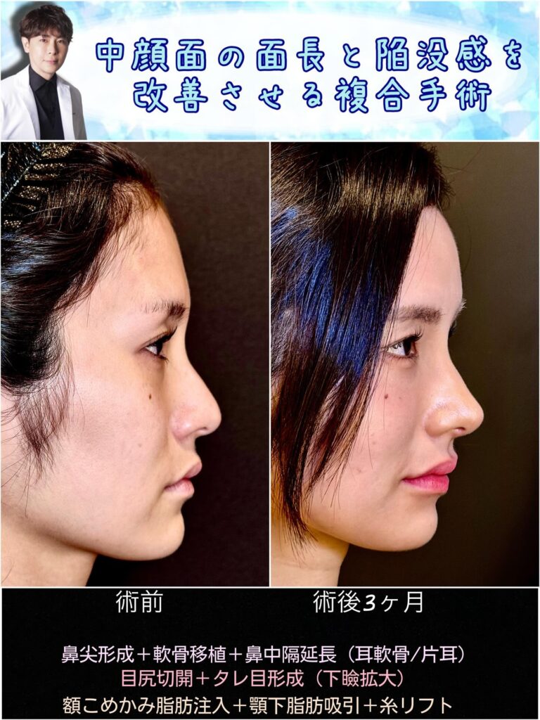 中顔面陥没を改善した横から見た症例写真