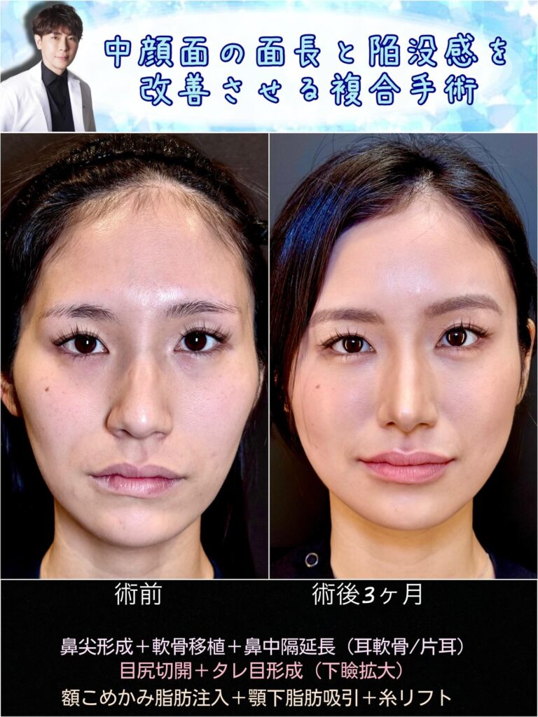 中顔面陥没を改善した正面から見た症例写真