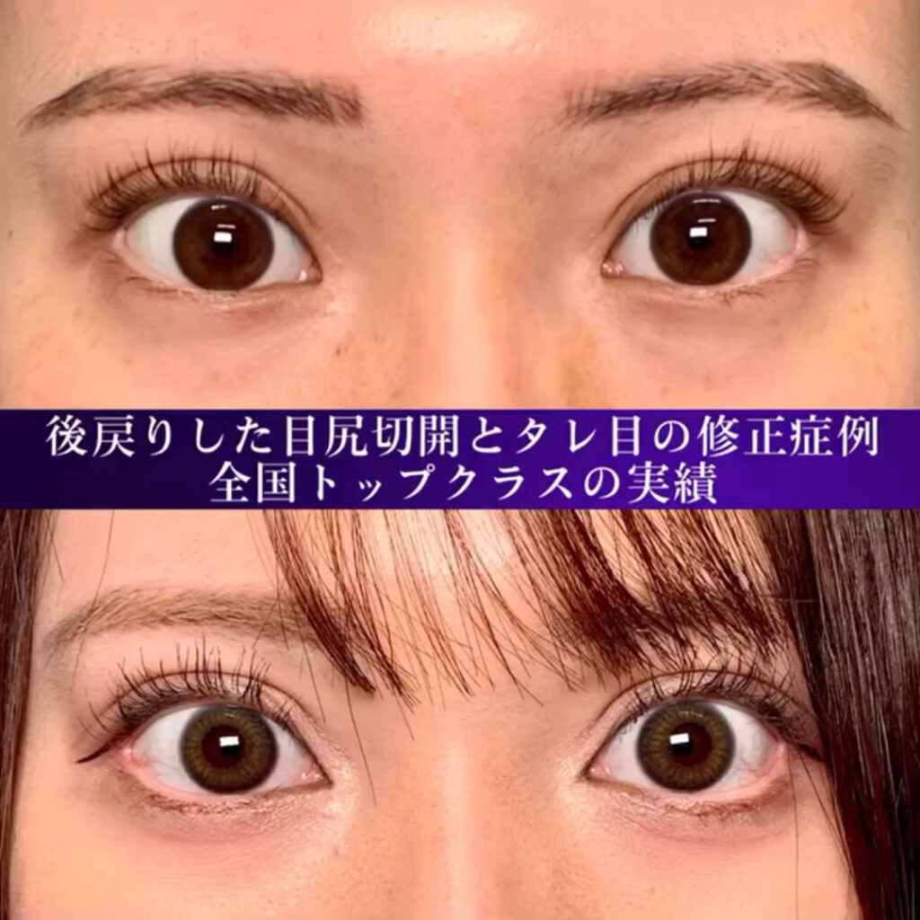 目尻切開とタレ目形成の他院修正の症例写真