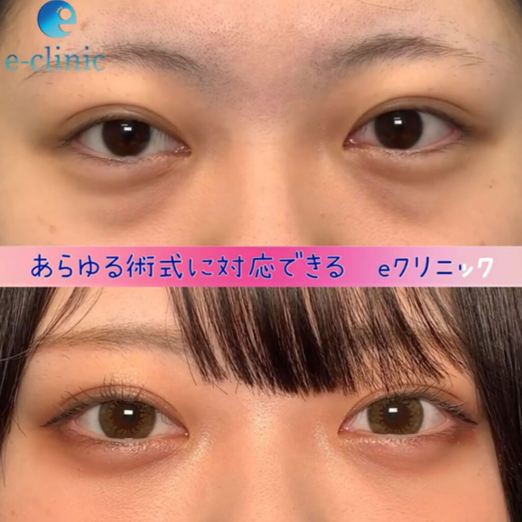 裏ハム法の症例写真