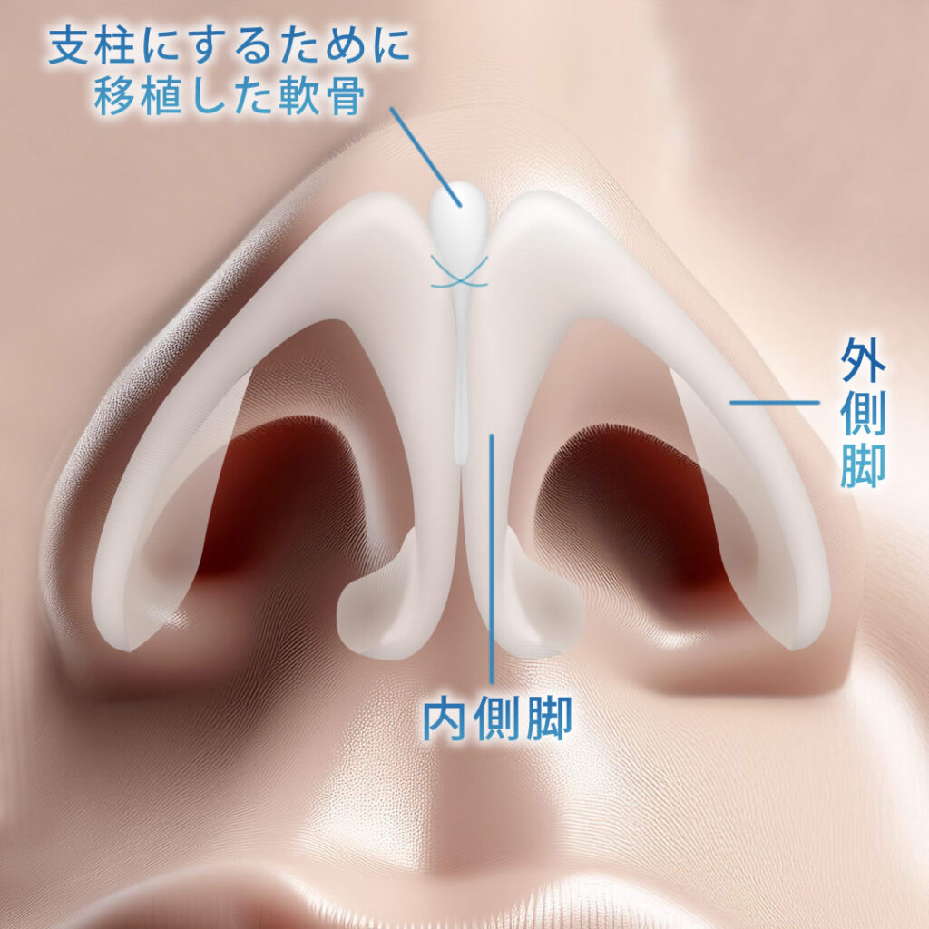 コルメラストラット法の図解