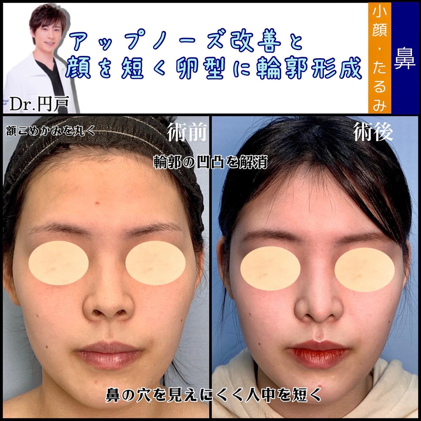 鼻の美容整形と脂肪注入の症例写真