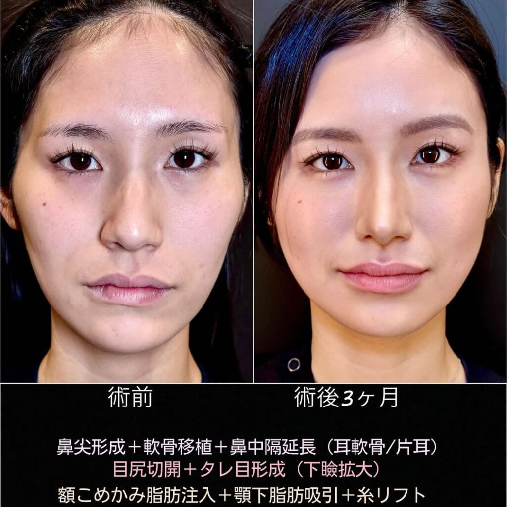 中顔面陥没整形の症例写真