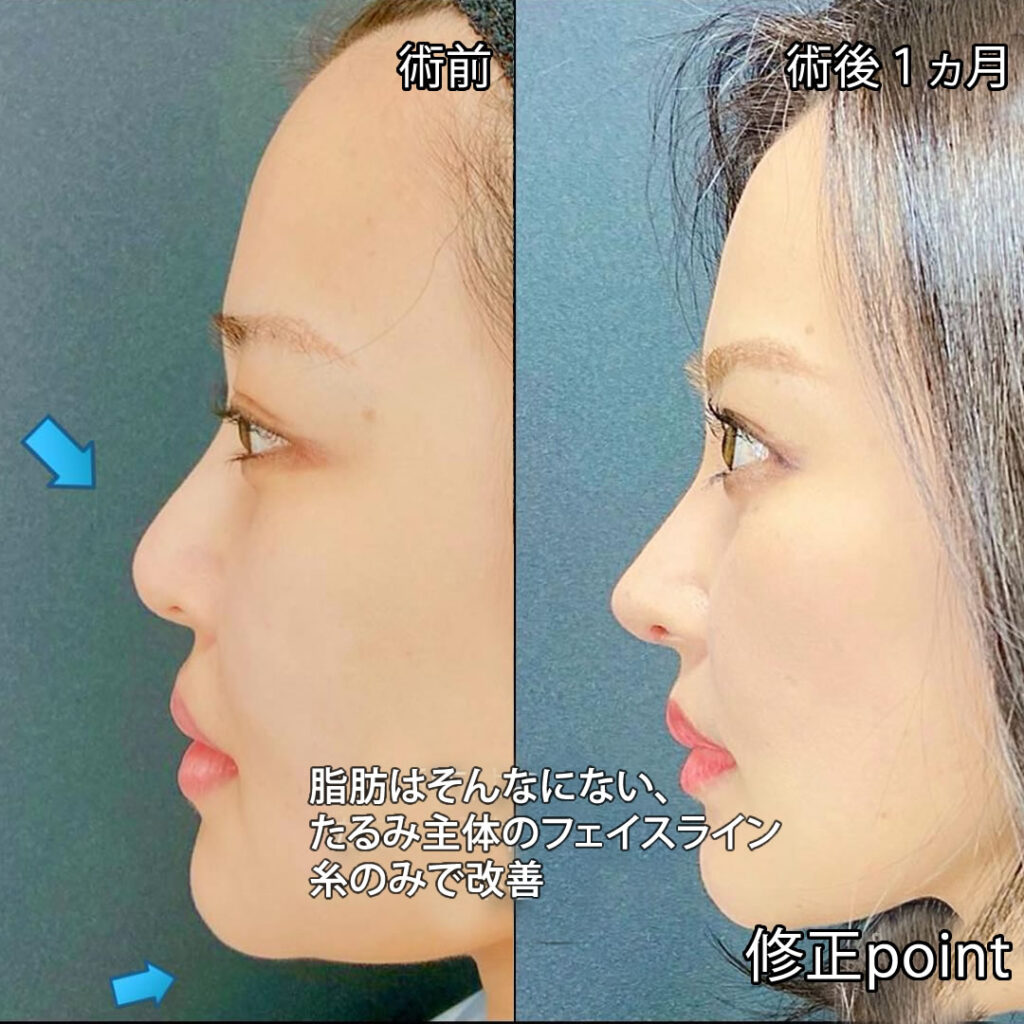 eラインを意識した鼻の他院修正