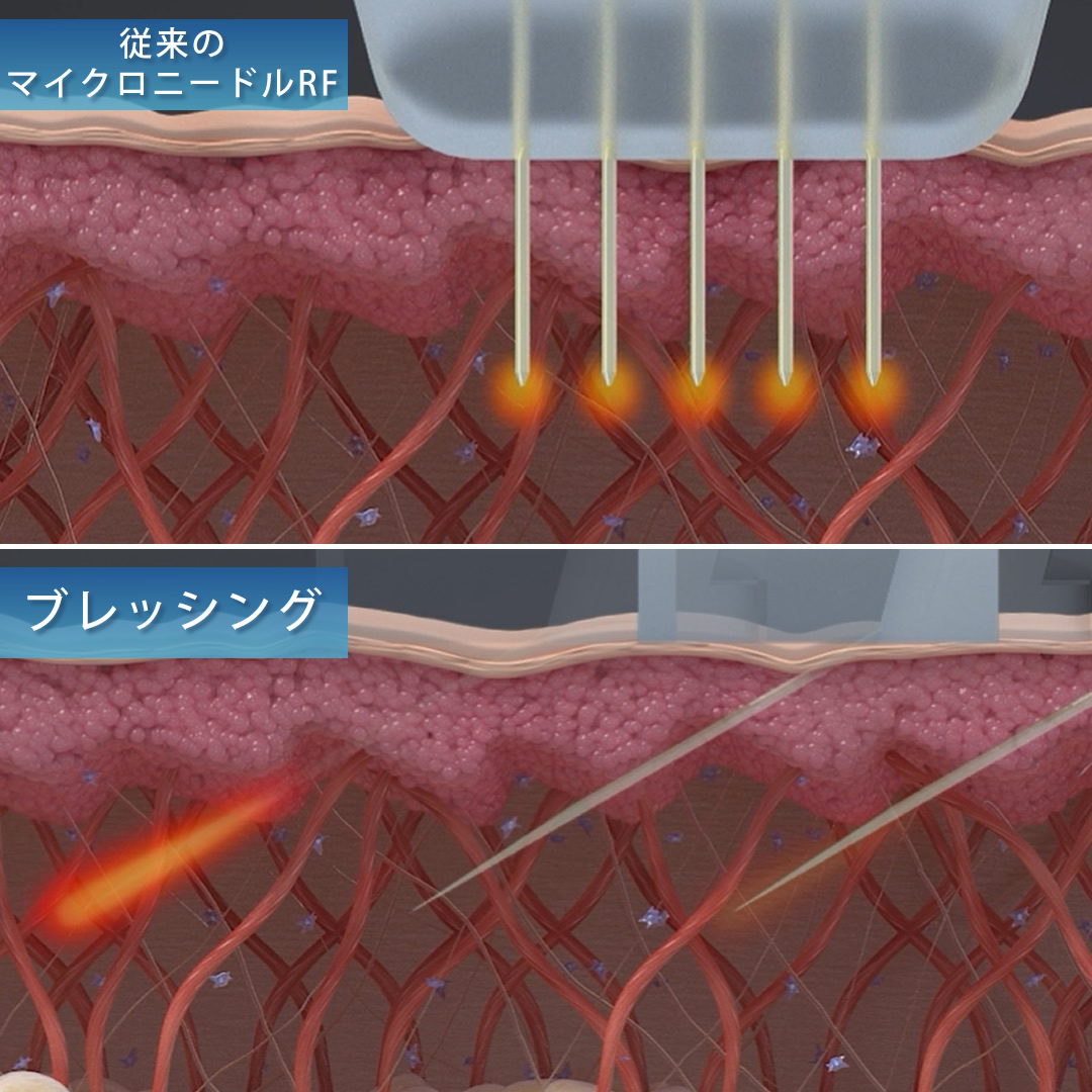 従来のマイクロニードルRFとブレッシングの違いの図解